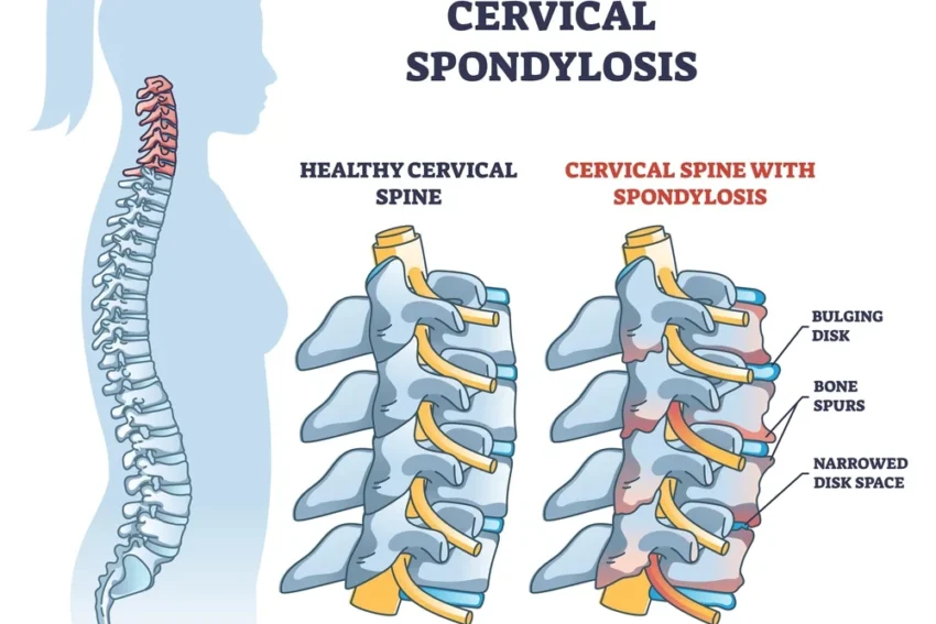 Cervical & Lumbar Spondylosis